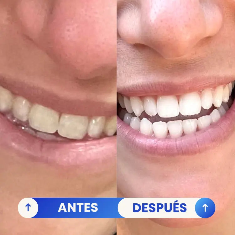Kit Blanqueador Pro® | Luce Dientes Más Blancos en Solo 20 Minutos